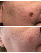 Image result for Keratosis Removal