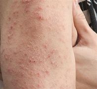 Image result for Gluten Allergy Skin Rash