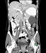 Image result for Mucinous Cystic Neoplasm Pancreas