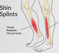 Image result for Shin Splints Injury
