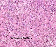 Image result for Dermoid Cyst Ovarian Gross Specimen