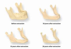 Image result for Jaw Bone After Tooth Extraction