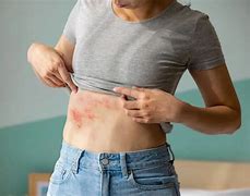 Image result for Shingles Stomach
