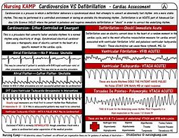 Image result for Pre Performed CPR in ECG