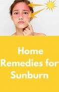 Image result for Sun Burn Home Remedy