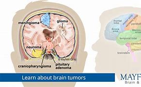 Image result for 2 Cm Brain Tumor