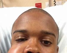 Image result for Hit in Face with Baseball