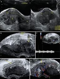 Image result for Adnexal Mass Ultrasound
