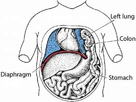 Image result for Diaphragm Hernia