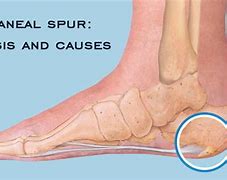 Image result for Bone Spur On Heel Treatment