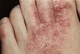 Image result for Types of Skin Allergies