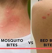 Image result for Bed Bug Bites On Stomach