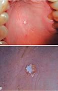 Image result for Tongue Papilloma