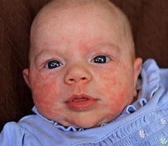 Image result for Eczema in Babies