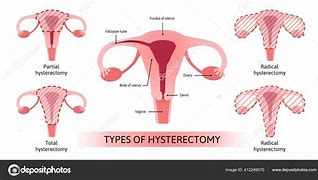 Image result for Hysterectomy Cartoon