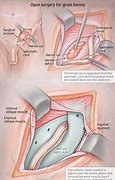 Image result for Hernia Surgery Choses