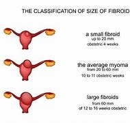 Image result for 10 Cm Fibroid