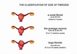 Image result for 5 Cm Fibroid Size