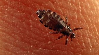 Image result for Head Louse