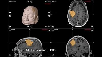 Image result for Meningioma Brain Tumor Surgery