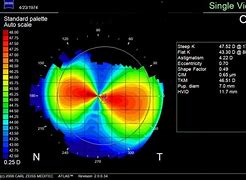 Image result for Corneal Topography Astigmatism