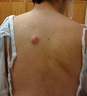 Image result for Back Cyst