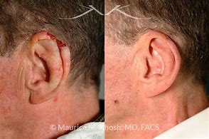 Image result for Outer Ear Flap