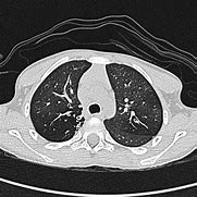 Image result for Pulmonary Nodule Attenuation