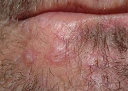 Image result for Histoplasmosis Rash