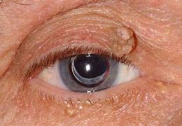 Image result for White Bump On Inner Eyelid