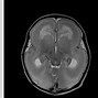 Image result for Classical Lissencephaly
