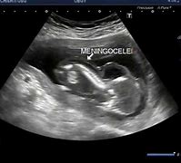 Image result for Meningocele Fetal Ultrasound