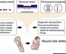 Image result for Neural Tube Defects