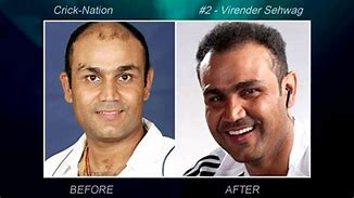 Image result for England Cricket Hair Transplant
