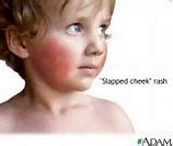 Image result for Fifth Disease Baby