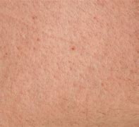 Image result for Keratosis Pilaris Chest