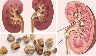 Image result for Kidney Full of Stones