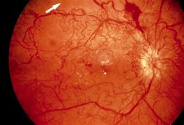 Image result for Retinopathy