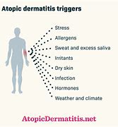 Image result for Eczema Triggers