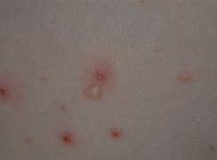 Image result for Molluscum Contagiosum Beetlejuice Treatment