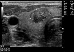 Image result for Thyroid Adenoma Ultrasound