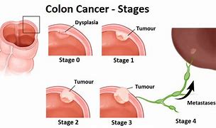 Image result for Colonoscopy Colon Cancer Stage