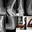 Image result for Dislocated Pelvis