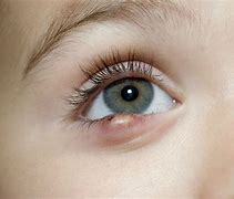 Image result for Growth On Lower Eyelid
