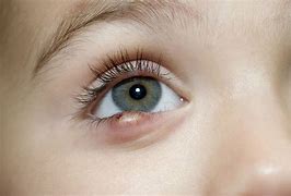 Image result for Eyelid Infection