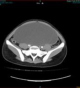 Image result for Giant Ovarian Cyst