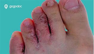 Image result for Signs and Symptoms of Athlete's Foot