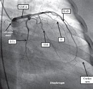 Image result for Blocked Coronary Artery Angiogram