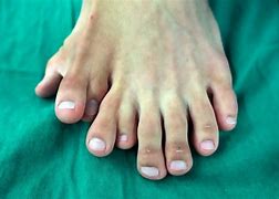 Image result for Feet 8 Toes