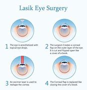 Image result for Laser in Situ Keratomileusis